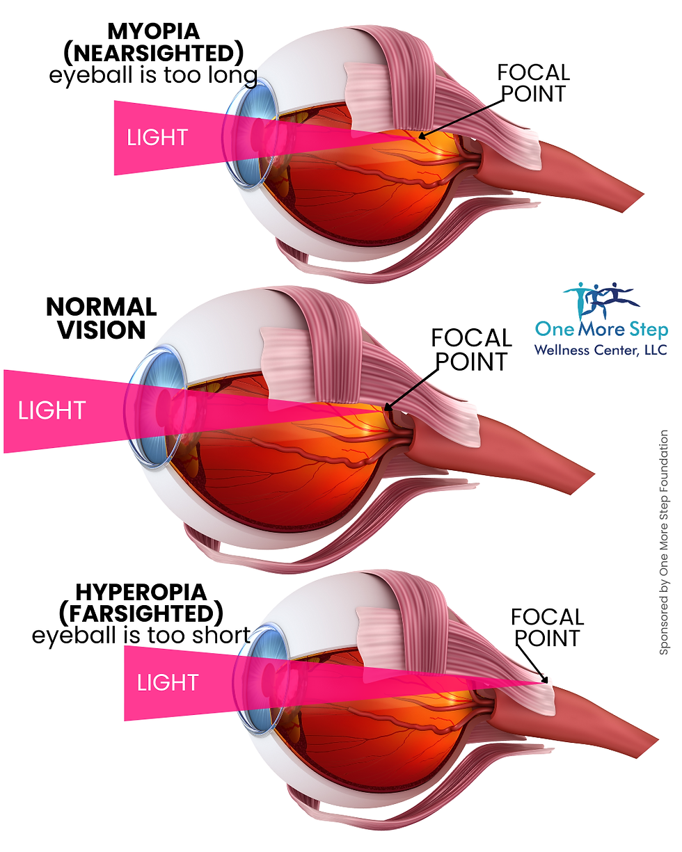 general idea of what happens when someone is myopic (nearsighted) - the eyeball is too long, more oblong than it should be, and the light ends up being focused in front of the back of the eye, whereas in normal vision the light is focused on the back of the eye, in hyperopia, the light would be focused behind the eye because the eyeball is too short