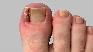 ingrown-toenail-treatment.webp