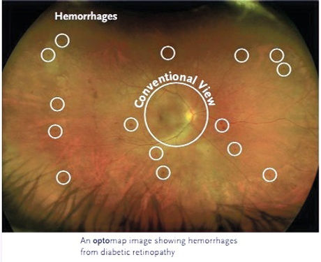 Diabetic Retinopathy_edited_edited.jpg