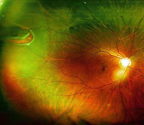 Περιφερειακη αρχομενη Αποκολληση αμφδους