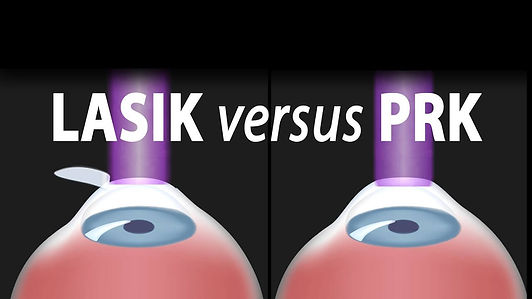 Διαφορές Trans PRK - Femto Lasik (3).jpg
