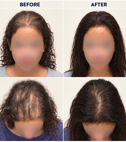 Unshaven FUE woman before and after