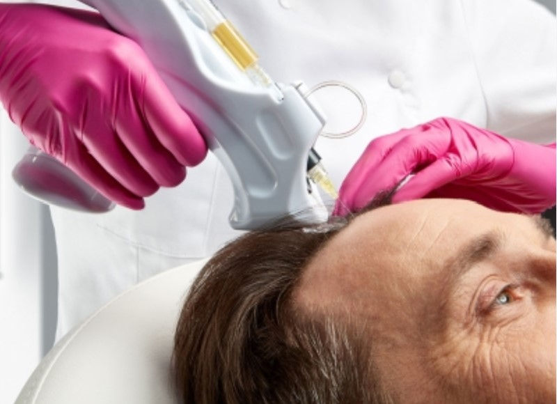 PRP:  Treating hair loss with your own "gold"