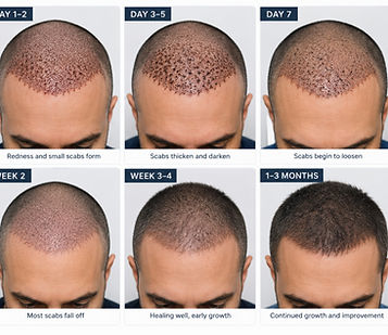 HT recovery progress