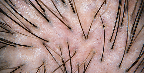Dermascopic scalp magnification and hair follicles