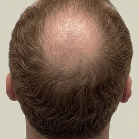 male hair transplant before and after