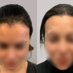 Female hair transplant before and after