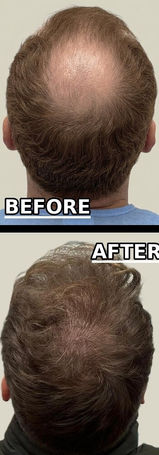 hair transplant before and after