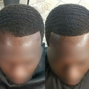 Before and after Afro hair transplant result