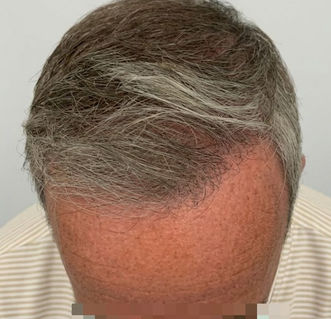 full head of hair after hair transplant
