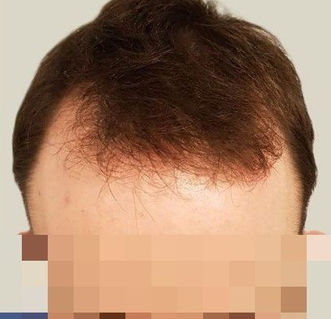 receding hairline in a man