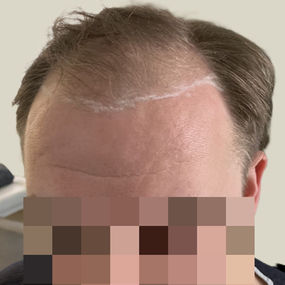 Male hair transplant before and after