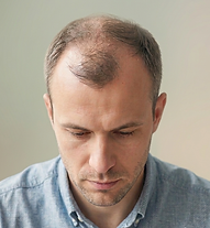Stages of male pattern hair loss
