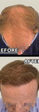 hair transplant before and after