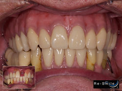 Natural looking denture
