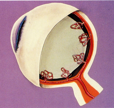 proliferative diabetic retinopathy blood sugar-related changes cause new abnormal retinal blood vessels to grow