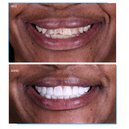 Diseño de Sonrisa - Dr. Mariano Estrada
