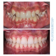 Diseño de Sonrisa - Dr. Mariano Estrada