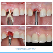 Dr. Mariano Estrada - Implantes Dentales
