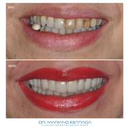 Diseño de Sonrisa - Dr. Mariano Estrada