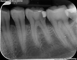 Dental_caries_ dentista_español_Londres