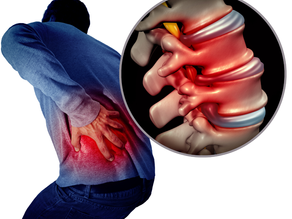 How To Quickly Eliminate Back Pain Without Being Held Hostage By A Herniated Disc