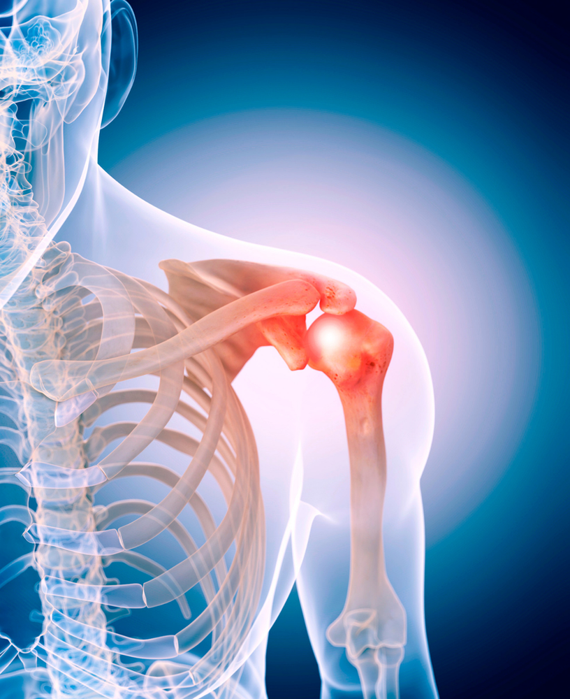 5 Step Solution for Shoulder Stiffness