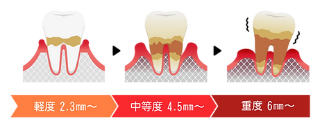 歯周病検査について