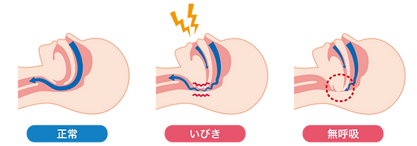 睡眠時無呼吸症候群の図解