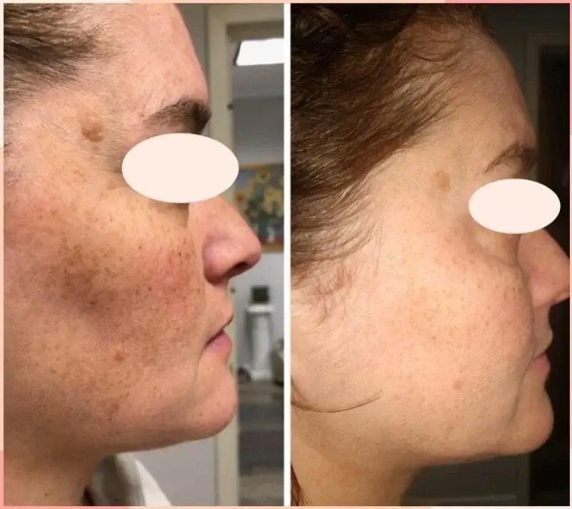 Thumbnail: Cell Core Pro LED Mask