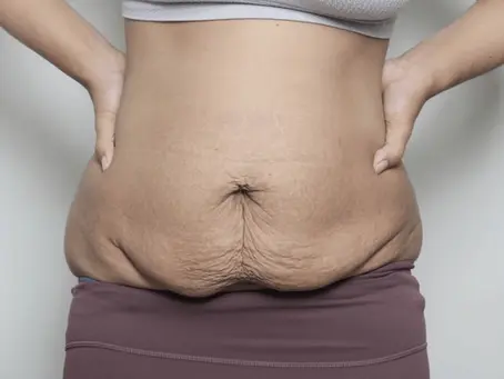 What Body Contouring Options Are Safe for Postpartum Body Reshaping?