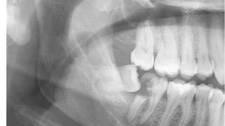 tercer molar.jpg