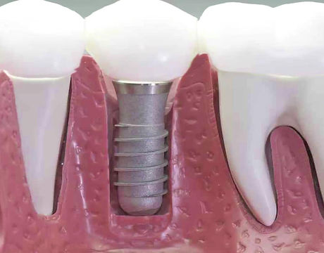 implantes.jpg