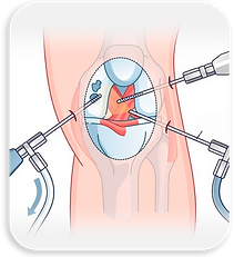 Artroscopia do Joelho.png