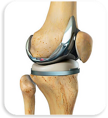 Artroplastia Total do Joelho.png