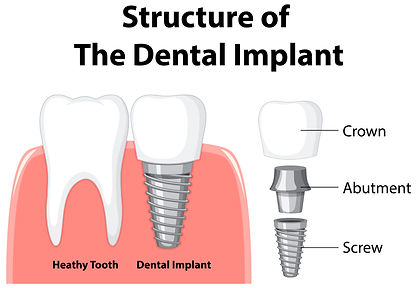 Dental Implants in Huntington Beach