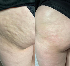 Anti Cellulite, Cellulitis, Anti Fettablagerung, schönere Beine, Haut
