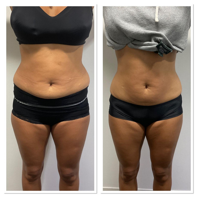lemon bottle fat dissolving side effects liver Xtreme Full article: Association of