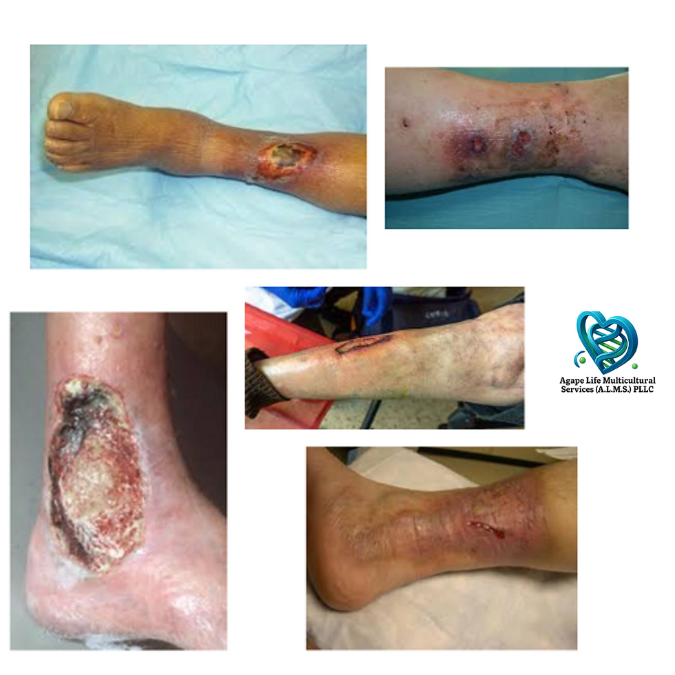 Arterial Ulcers