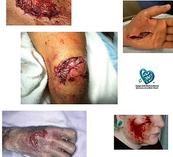 Traumatic Wounds ALMS treats