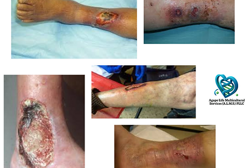 Arterial Ulcers ALMS treats