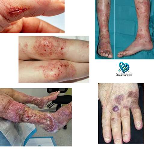 Infected Wounds