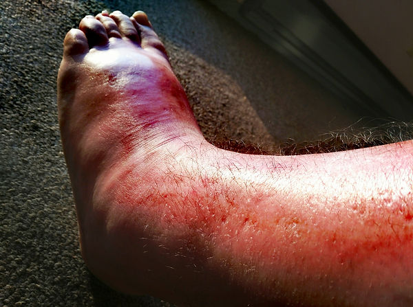 swollen ankle