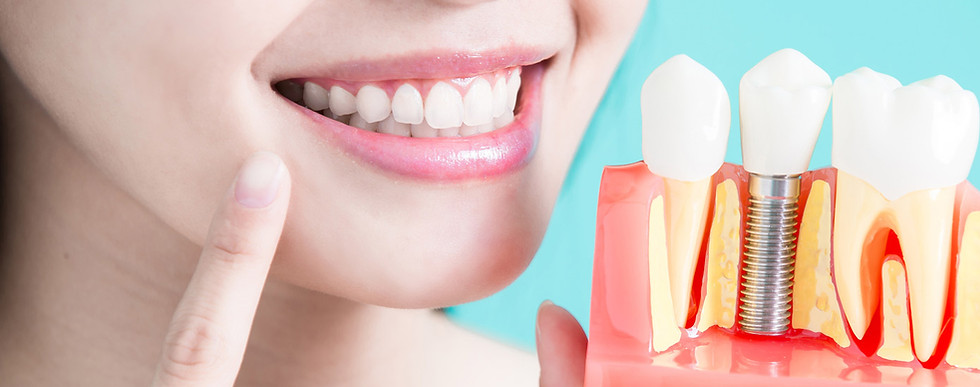 Rye Dental Implants