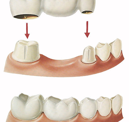 dental_bridge.jpg