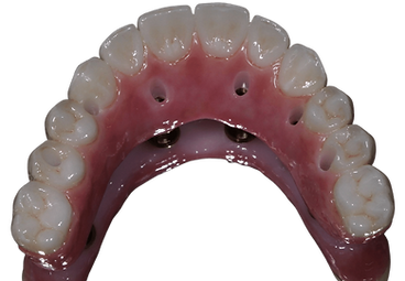 Artificial Teeth-in-a-day at Riverside Cosmetic and Implant Dentistry