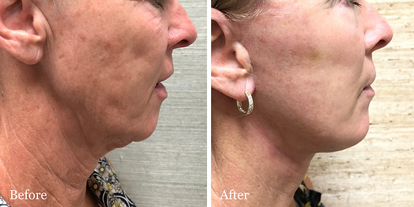 Before and After Facelift & Necklift on female patient by Dr. Azzi in Jupiter, Florida