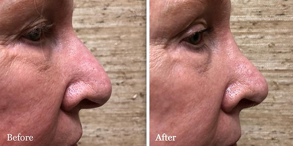 Revision Rhinoplasty on female patient -