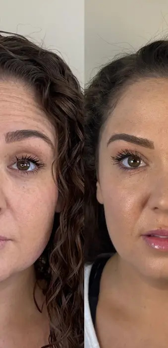 Full face Botox before and after showing improved skin smoothness and reduced fine lines