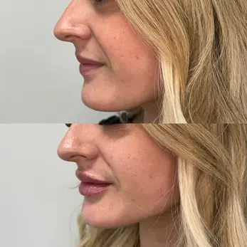 Before and after lip augmentation left semi-side view highlighting enhanced lip volume and shape.